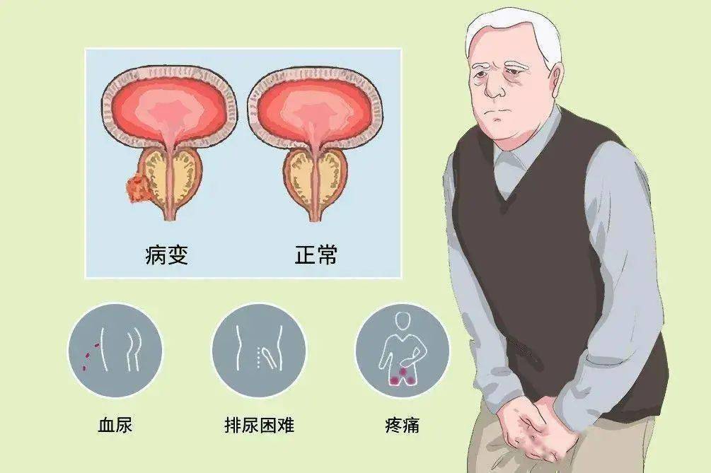 人到中年,你的前列腺还行吗?