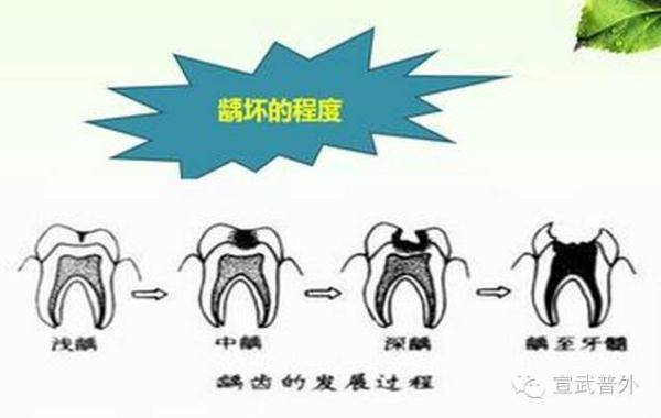 牙齿|牙疼不是病，疼起来要人命