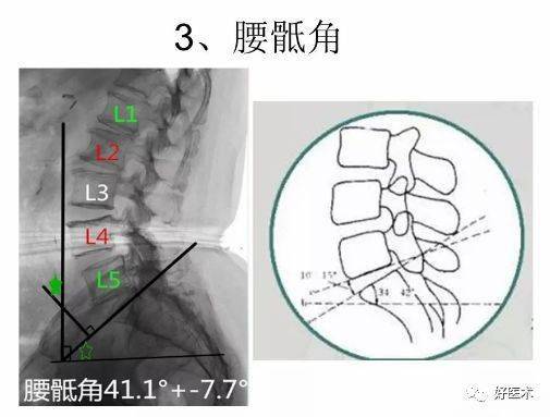 骨科常用的角度测量方法汇总全在这里了