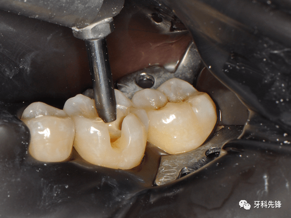 病例后牙美塑充填