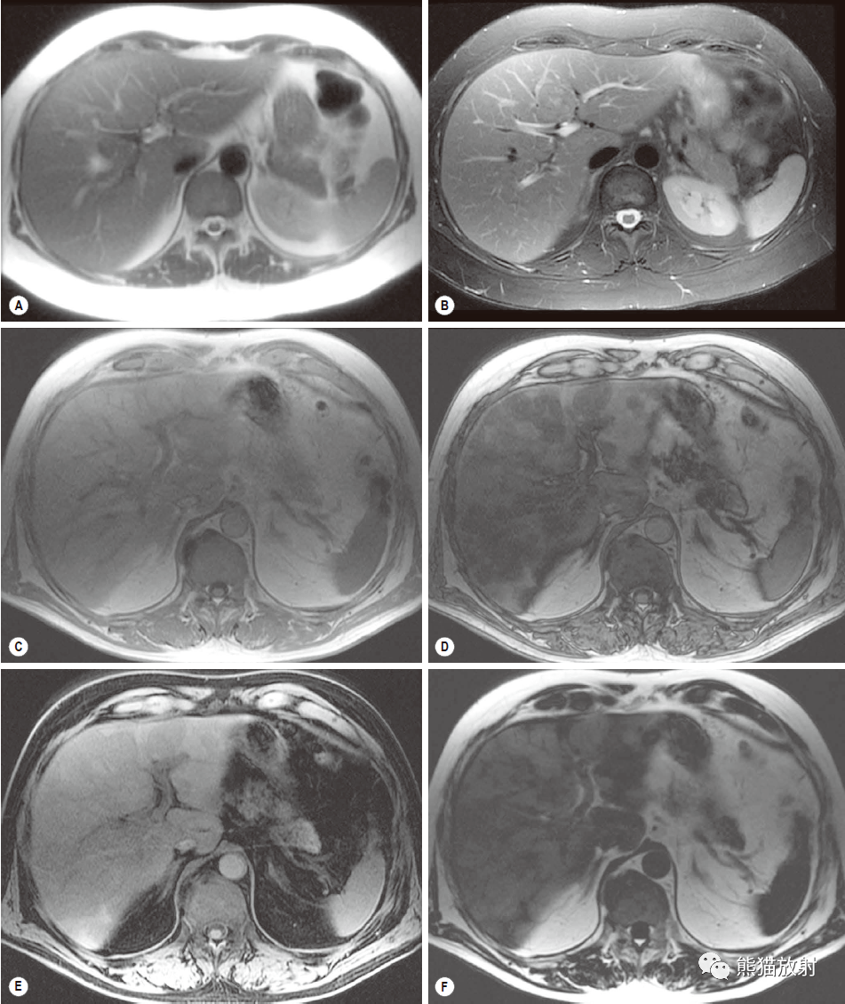 格艾选读丨肝脏影像检查技术（CT/MRI）_对比