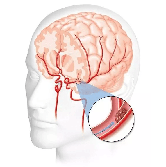 积医科普脑梗死的防治