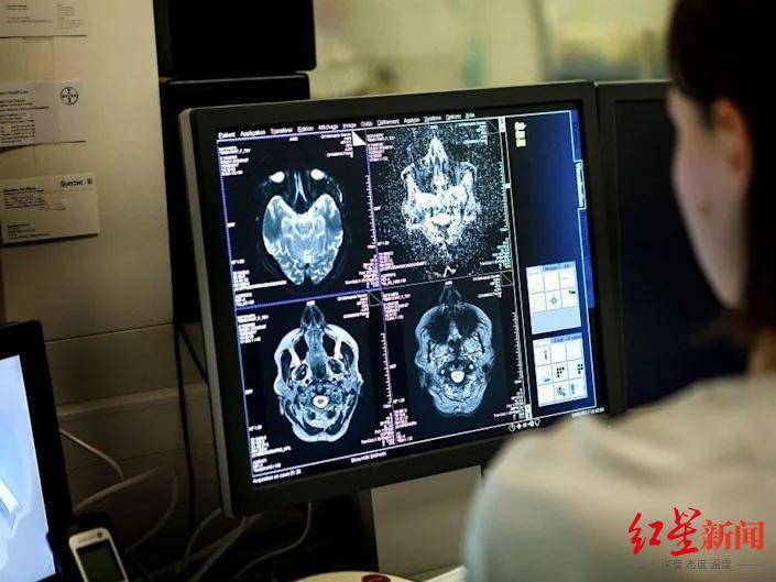 病毒|高达84%新冠感染者出现后遗症，最新研究：新冠病毒还能杀死脑细胞