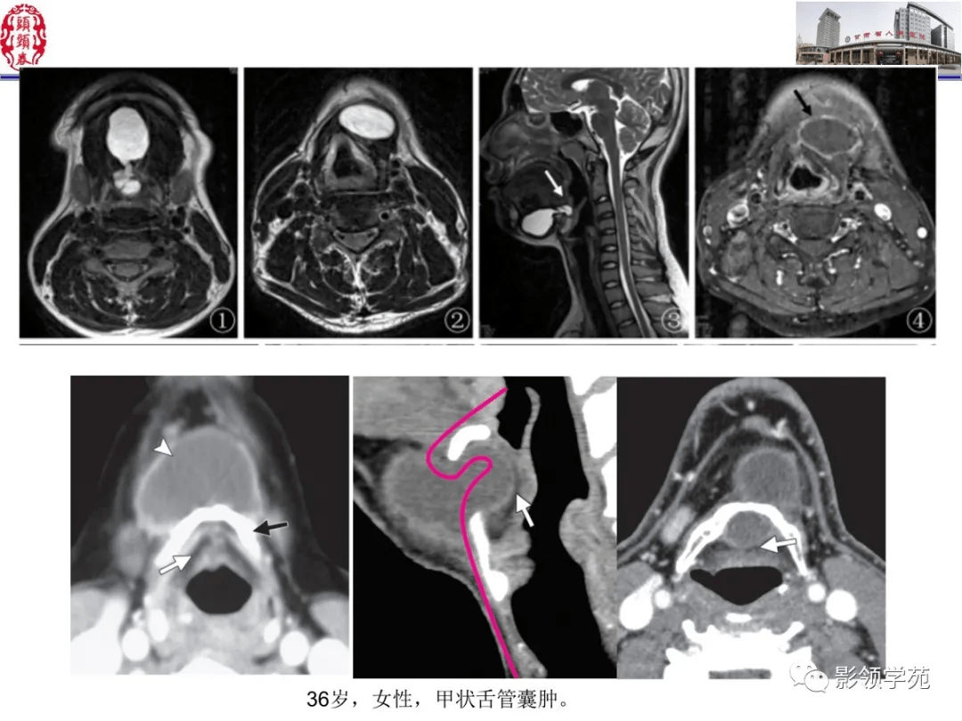 舌,口底影像解剖及常见疾病影像诊断_平台