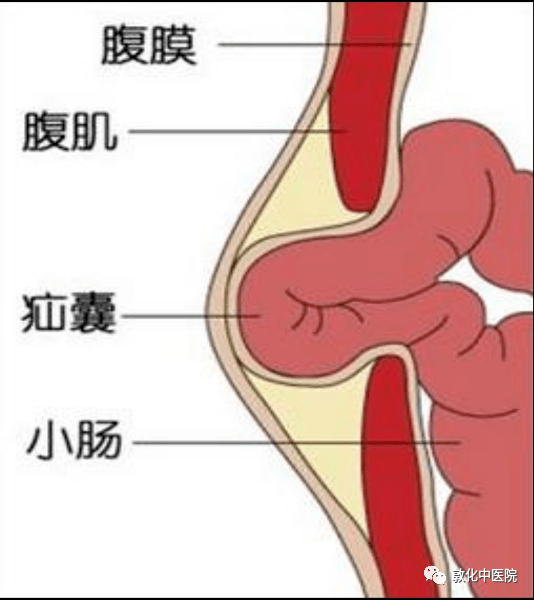 腹外疝解剖图图片