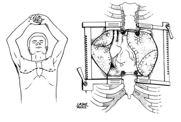 开胸手术切口示意图图片