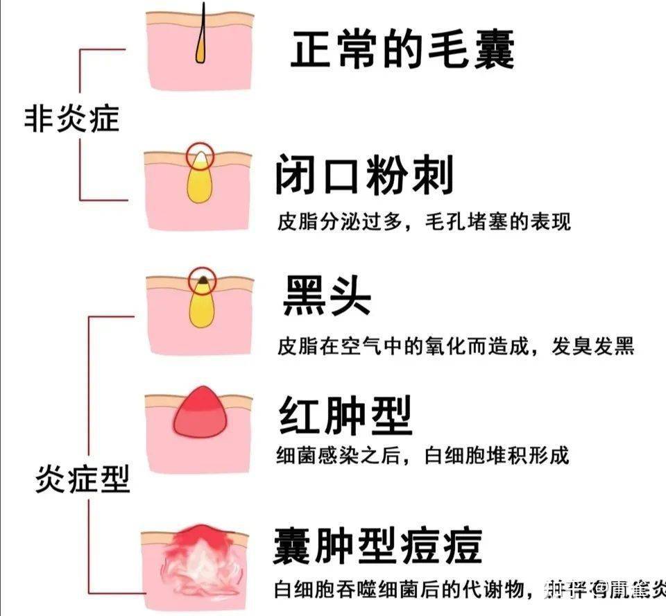 油皮的問題,這張圖就能說明白.