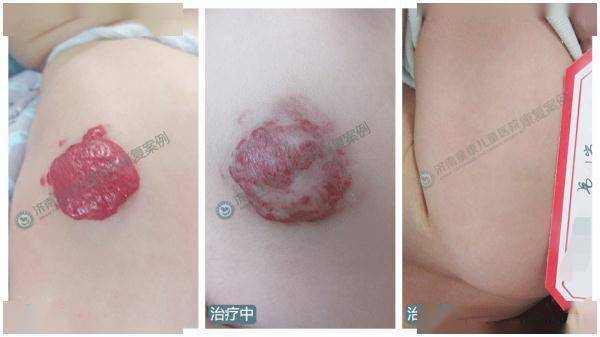 检查|10岁孩子险被截肢，只因身上长了这个很常见的东西