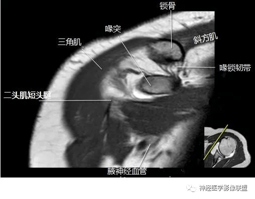 影像解剖肩关节磁共振断层
