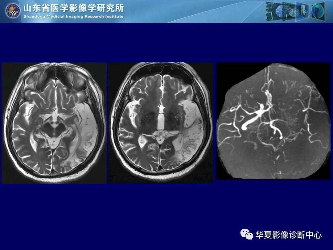 诊断|缺血性脑血管病的影像诊断