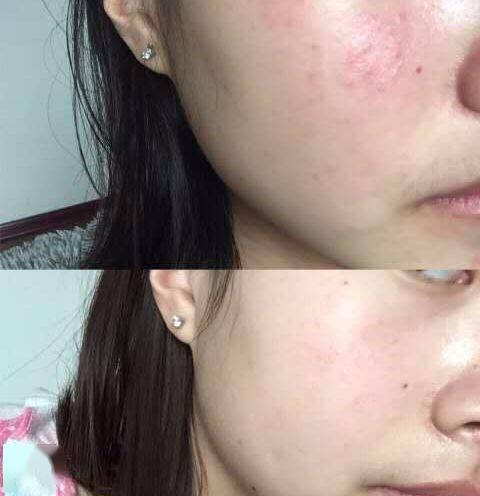 除此之外,五倍子中鞣酸成分,与皮肤溃疡面,黏膜,破皮处接触后,会形成