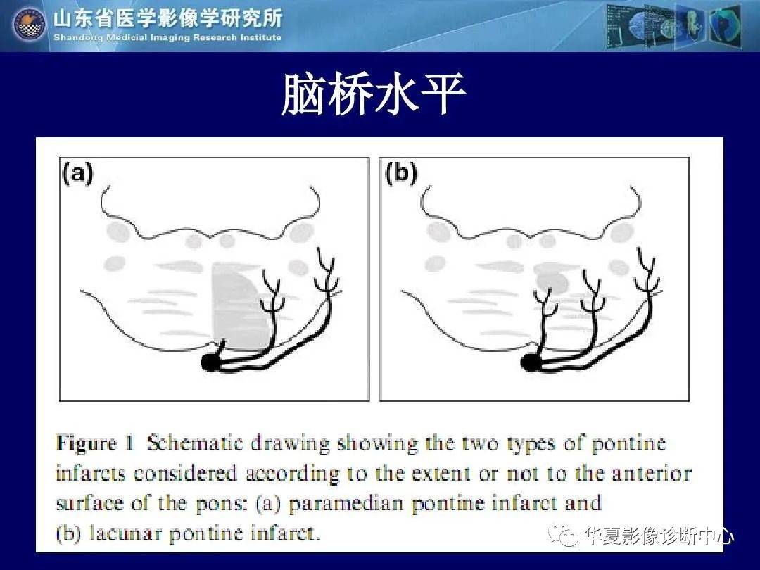 诊断|缺血性脑血管病的影像诊断