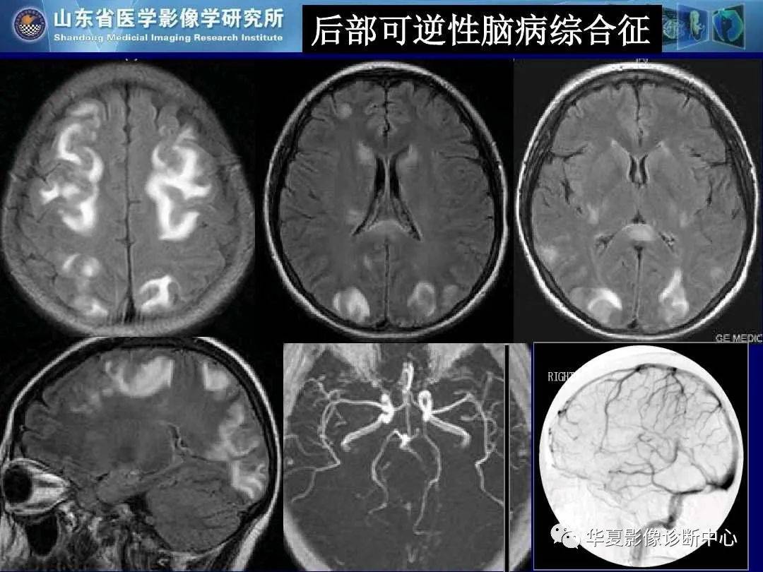 诊断|缺血性脑血管病的影像诊断