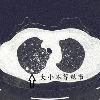 收藏十二个病人的肺ct图像详细解读