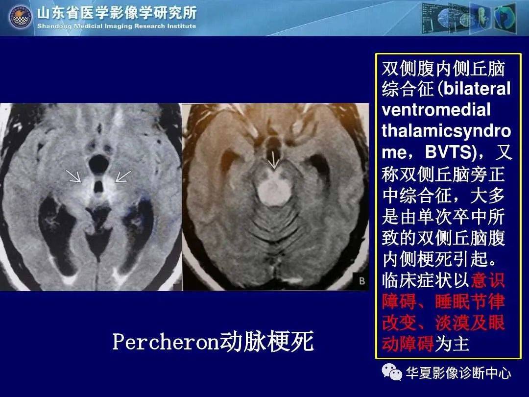 诊断|缺血性脑血管病的影像诊断