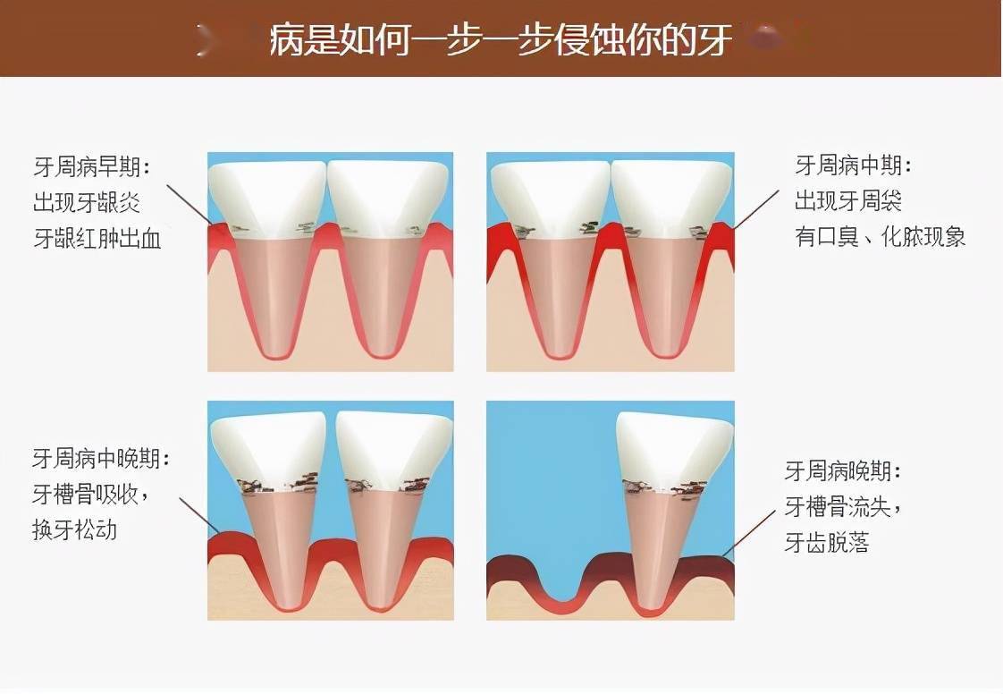 中度牙周炎可出现咀嚼无力,口臭,牙龈退缩,牙根暴露,牙床肿痛即所谓的