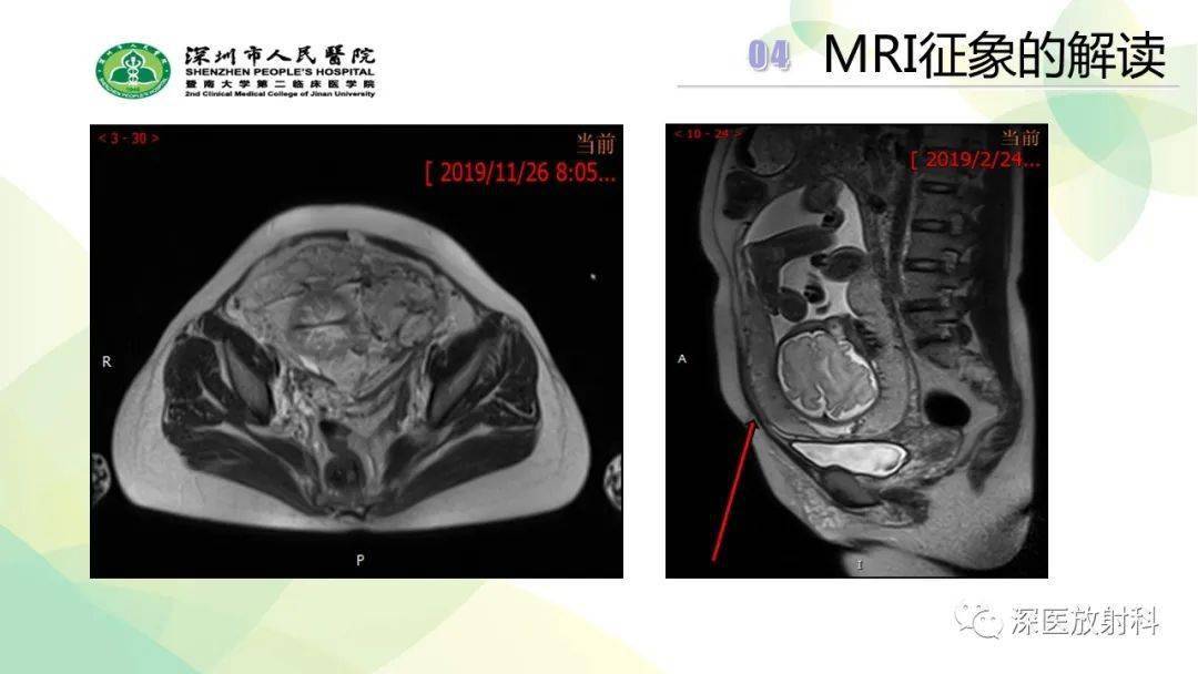 核磁共振胎盘植入图片图片