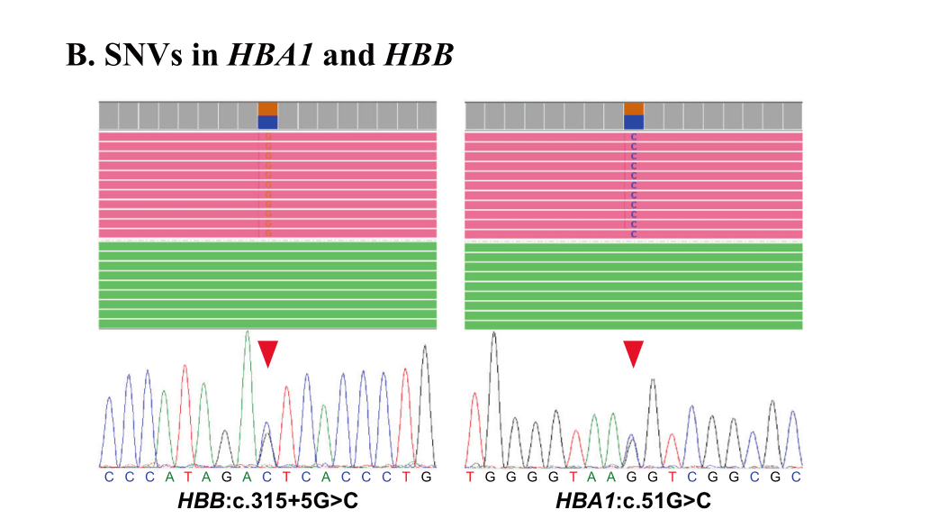 最新进展丨三代测序地中海贫血基因图谱项目成果见刊