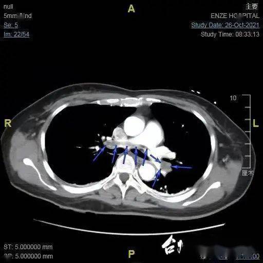 台州|24小时连救4人！医生惊呼：这个凶险病情，好多台州人身上都有！