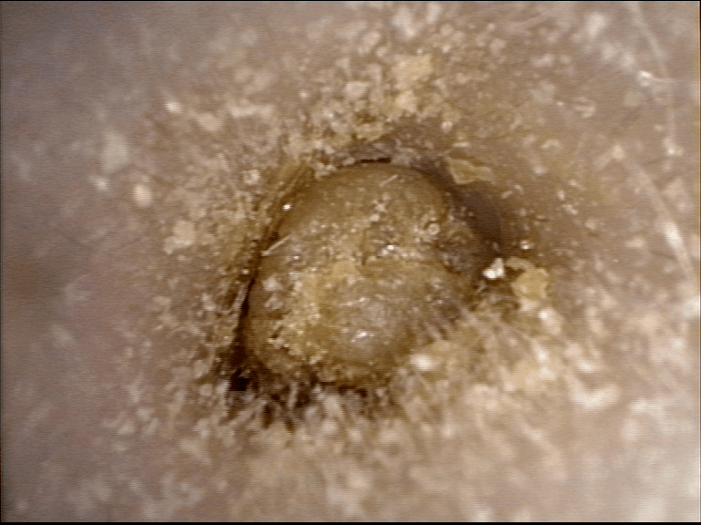 孩子的耳屎你挖对了吗