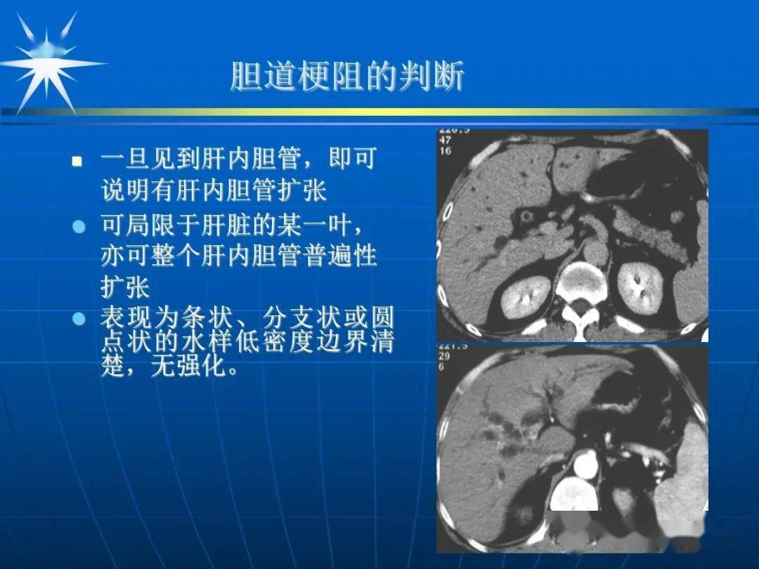 胆道系统ct解剖图图片