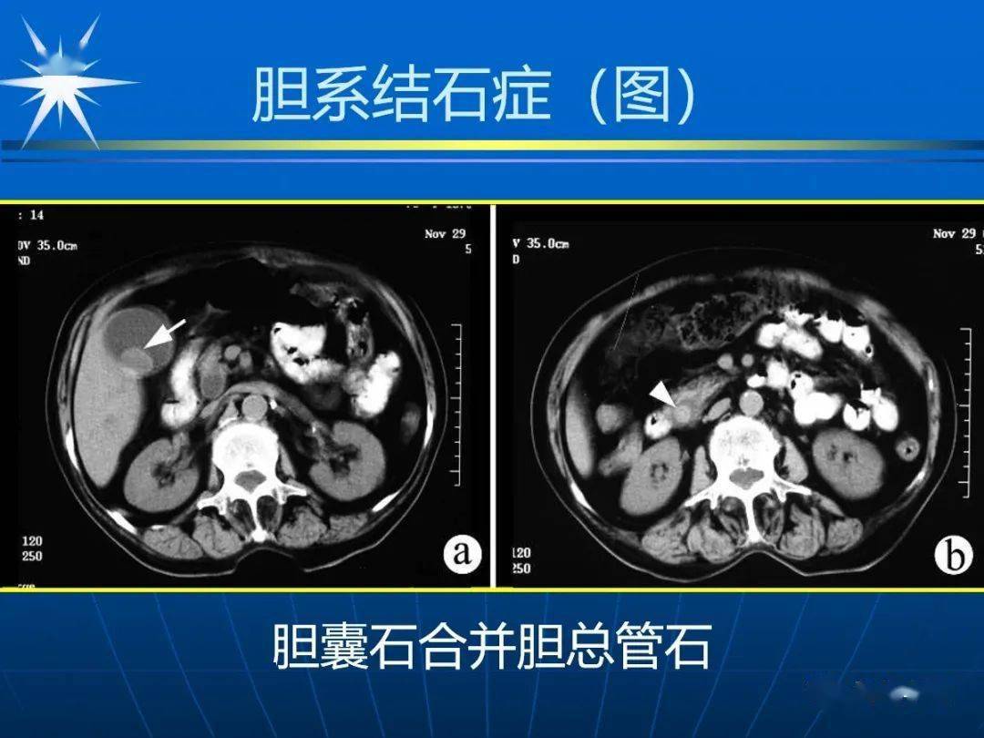 胆总管CT图片