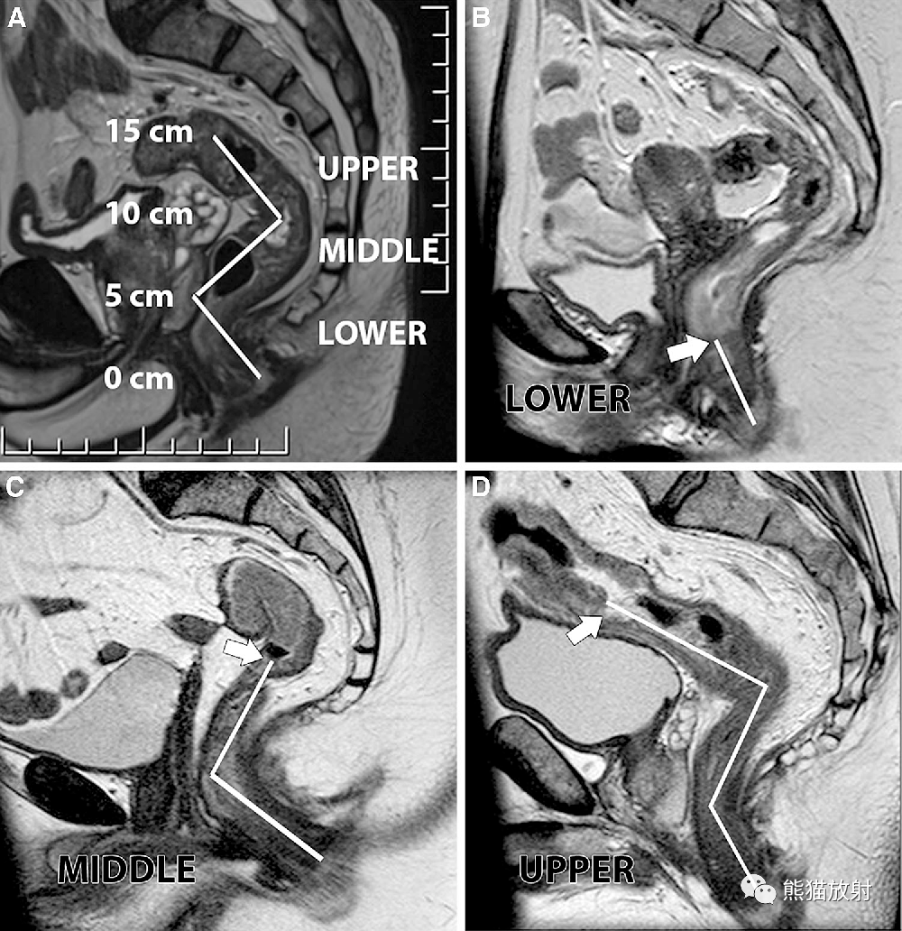 图a:直肠从肛管延伸至直肠乙状结肠交界处约15cm,分为下段(0-5cm),中