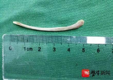 女子|女子吞5厘米长鸡骨头刺穿胃 ！