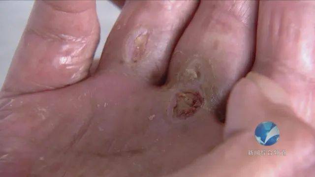 八旬老伯中了寒冰烈火掌24小时冰块不离手