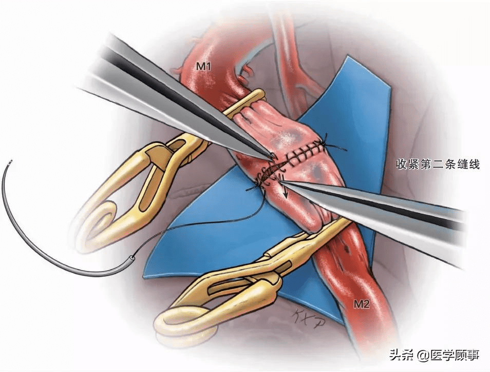 脑血管端端吻合技术