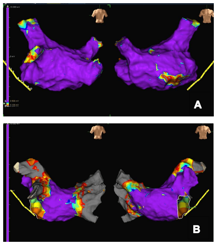 谢双伦|房颤消融有了“第三股力量”，广州完成华南首例脉冲场消融