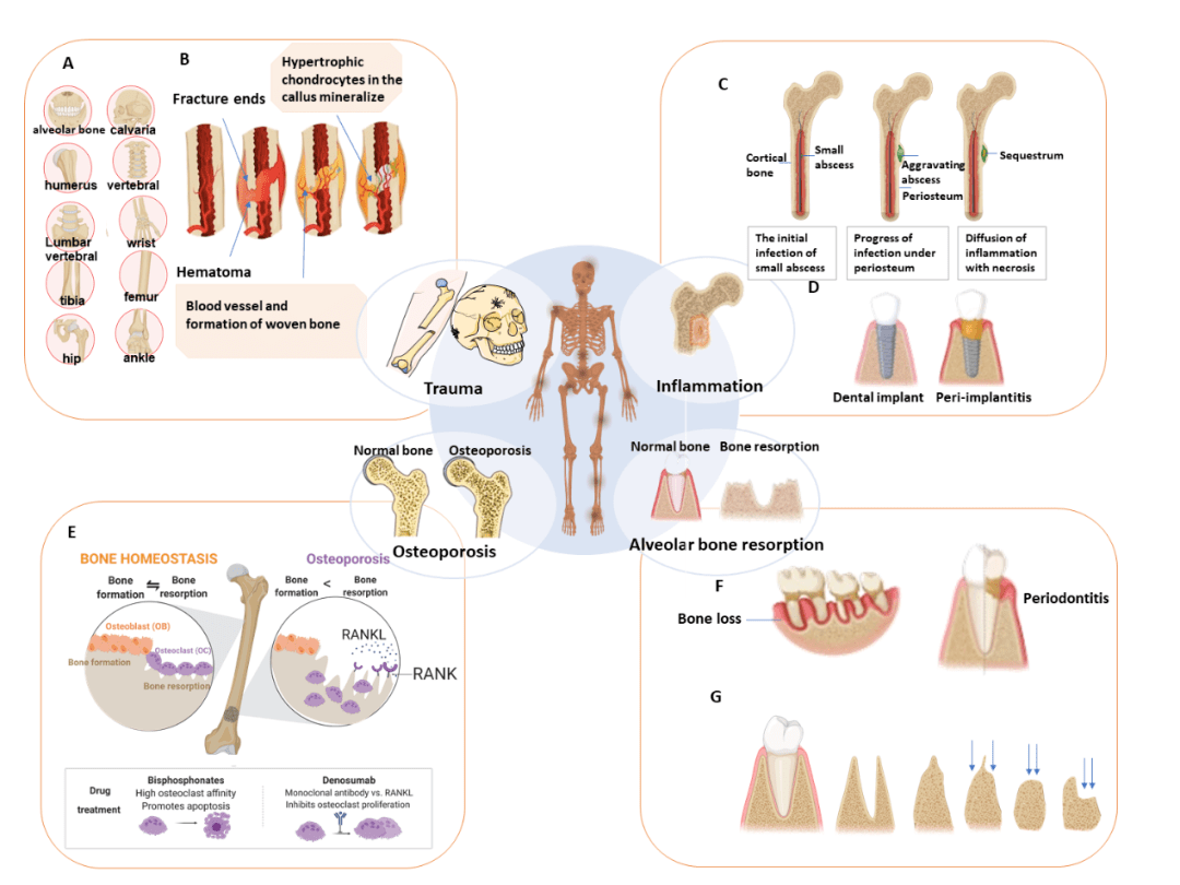 exploration | 生物材料和納米醫學的骨再生應用:進展和未來前景_臨床