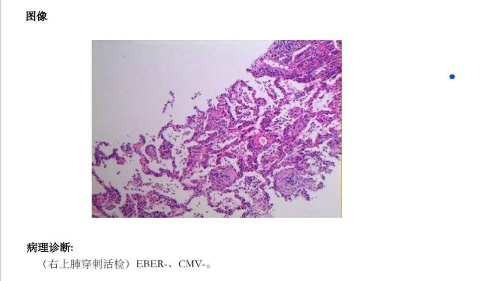 检查|【新闻快递】呼吸重症监护室成功开展两例危重症患者“床旁超声引导下经皮肺穿刺组织活检术”