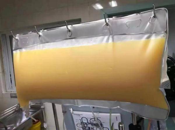 饮食|血液中透析出2升油浆，只因小伙爱吃这个