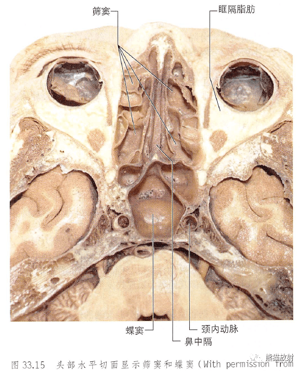 鼻旁窦解剖图3D图片