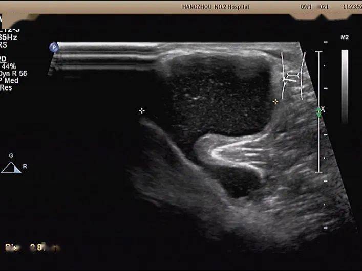 图 20 腘窝囊肿图片来源:作者提供鉴别诊断1, 小腿血肿当腘窝囊肿破裂