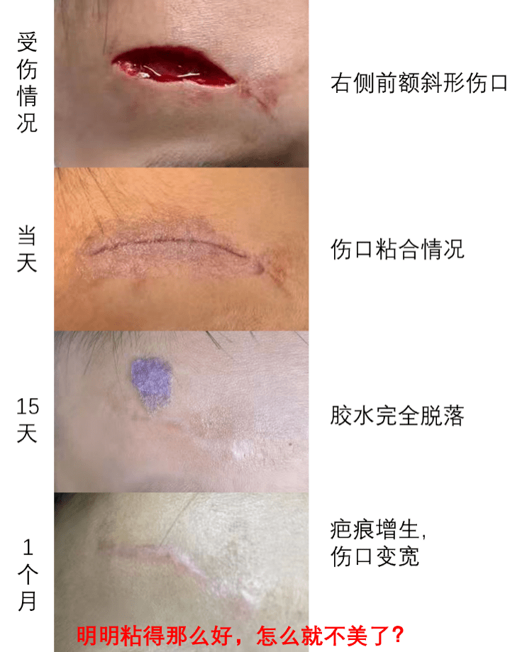 为什么被线形切开后的伤口不是一条线而是梭形?