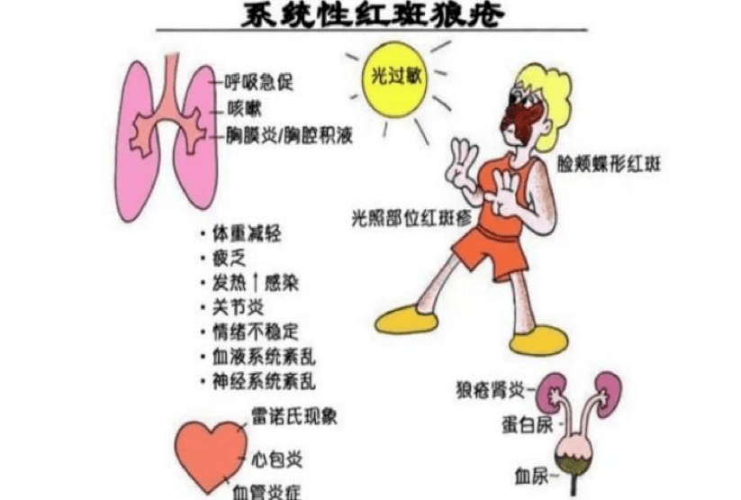 治疗|“战狼”宝典 | 系统性红斑狼疮的自白书