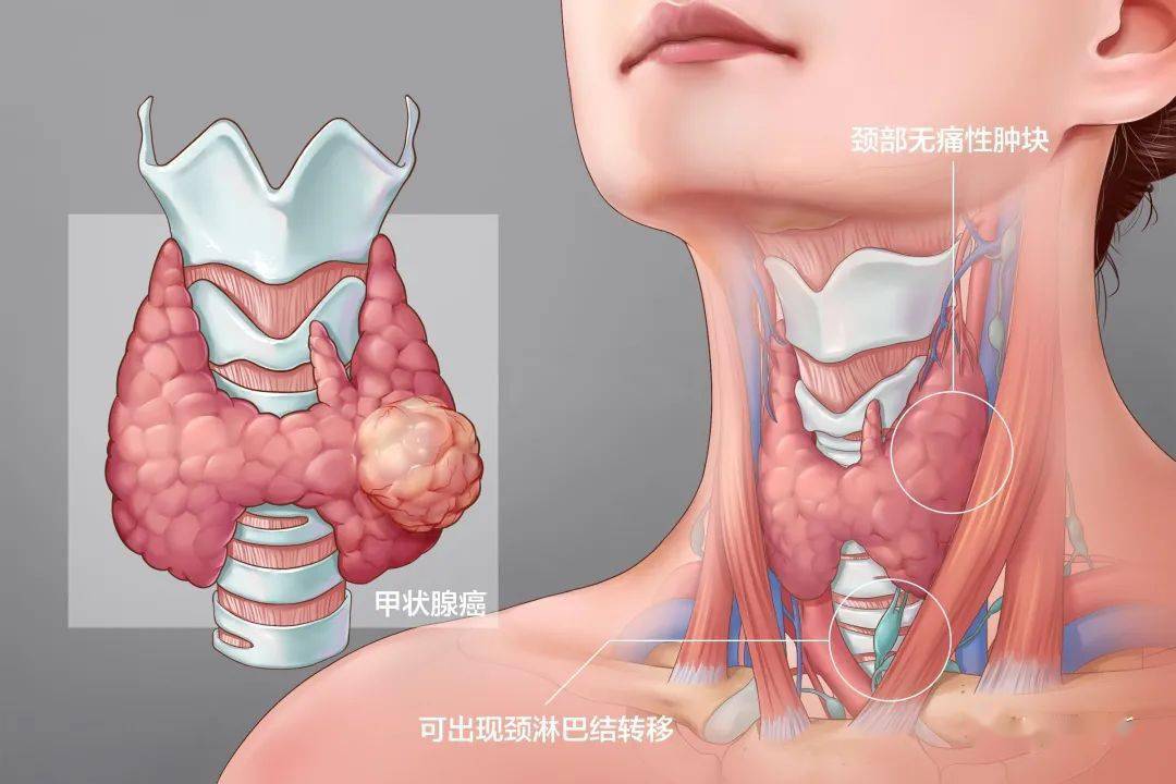 图/百度健康医典甲状腺癌起源于甲状腺上皮滤泡甲状腺癌的恶性肿瘤,常