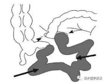 相应表现。此型疝与肠管自粘连带下方脱出形成的闭袢性肠梗阻鉴别困难。
