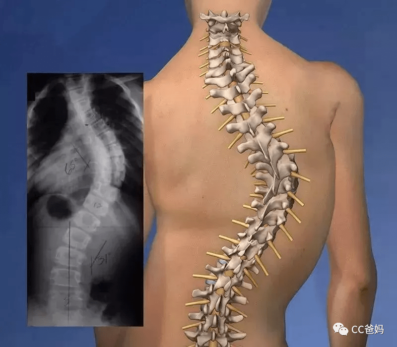 每6个孩子就有一个脊柱侧弯,只因10岁前家长忽略了这一点,90%父母都不