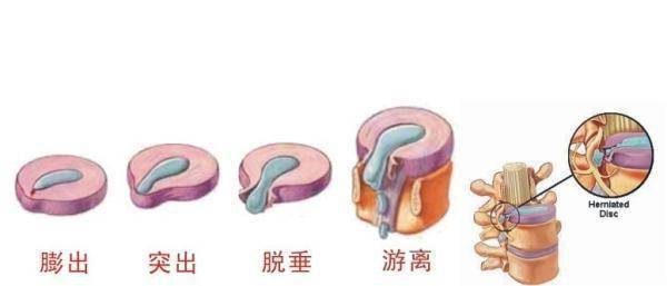 腰部|什么是腰椎间盘突出？突出的到底是什么？