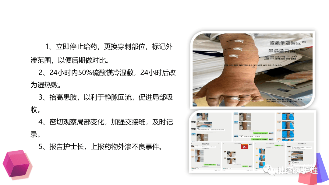 ppt一例脂肪乳外渗案例分析