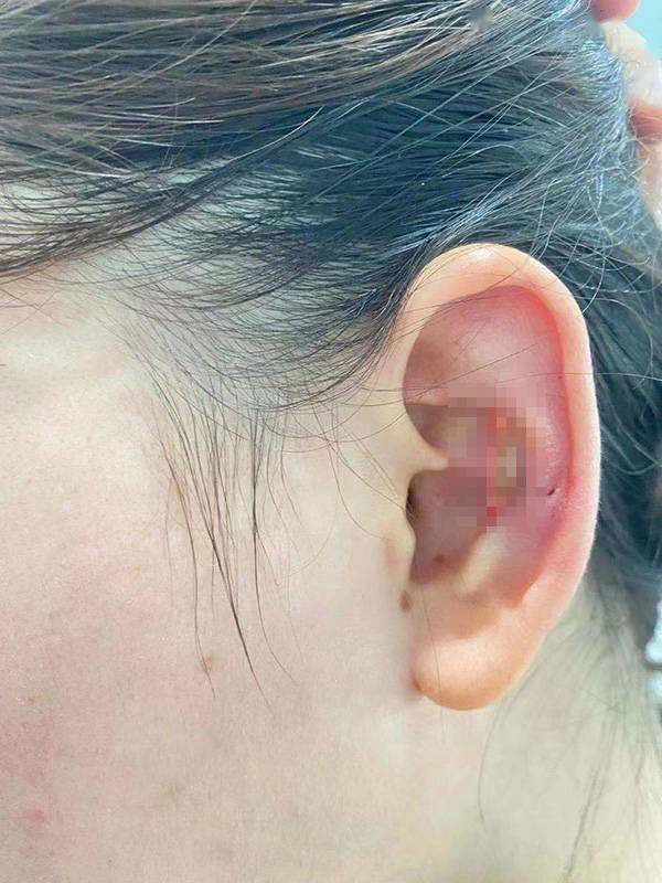 女子取耳软骨隆鼻致耳组织坏死,整形医院:先治疗,会恢复的