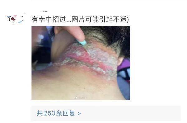 这种虫，是会飞的“硫酸”