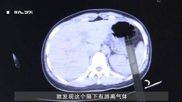 女生|女大学生一次吃太多辣条后肠穿孔，医生提醒这类食物要少吃