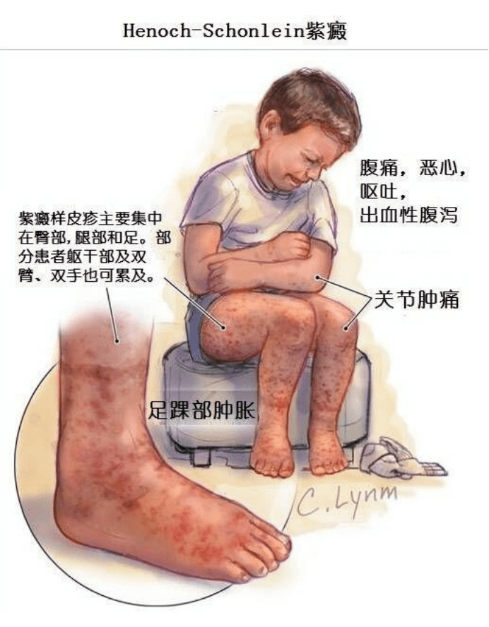 治疗|血液灌流，过敏性紫癜患儿的新选择