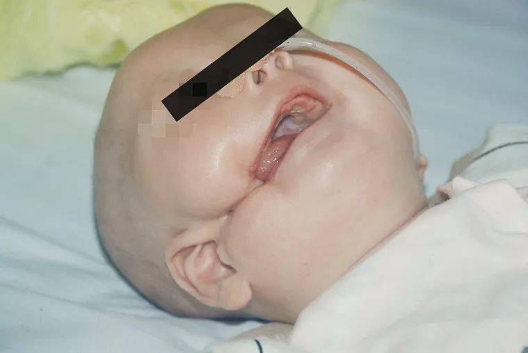 裂隙|左脸微笑的孩子