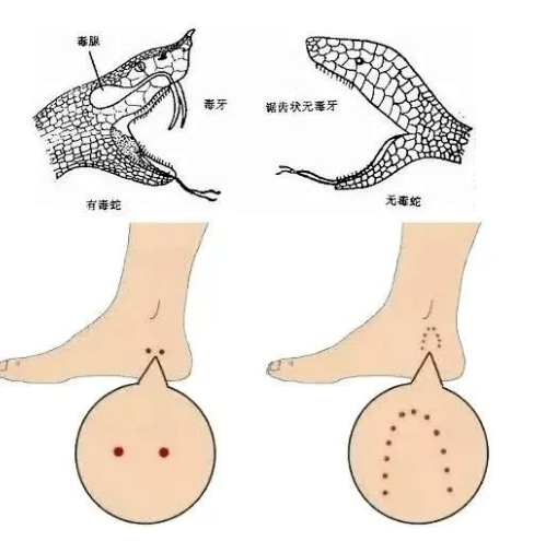 急救措施牢记:户外被蛇咬伤,视情况决定是否需要清理伤口,如有毒蛇咬