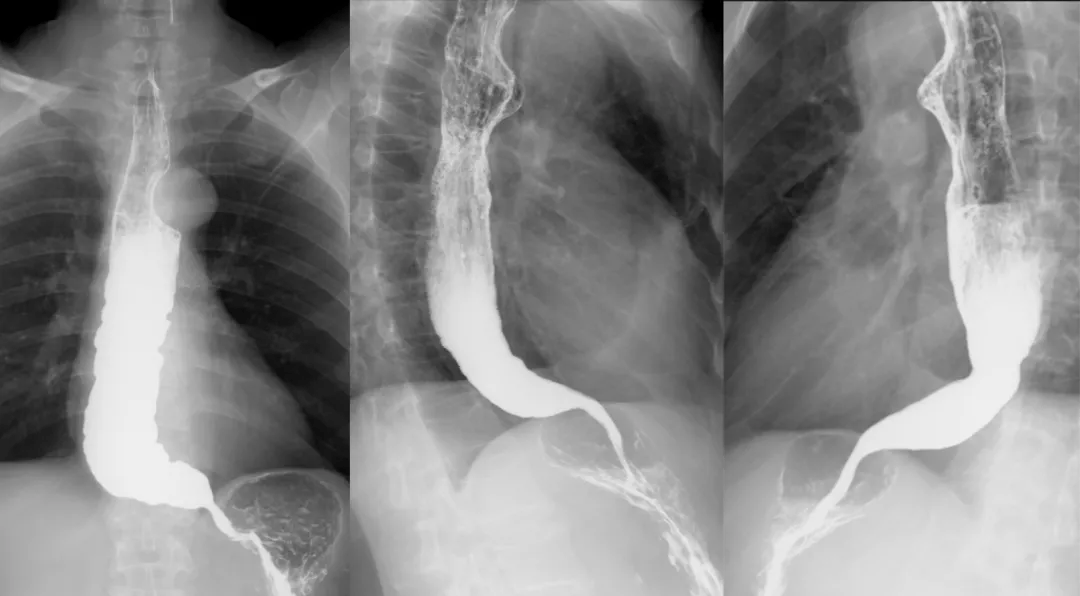 通过病例一起来学习食管影像解剖和非肿瘤性病变